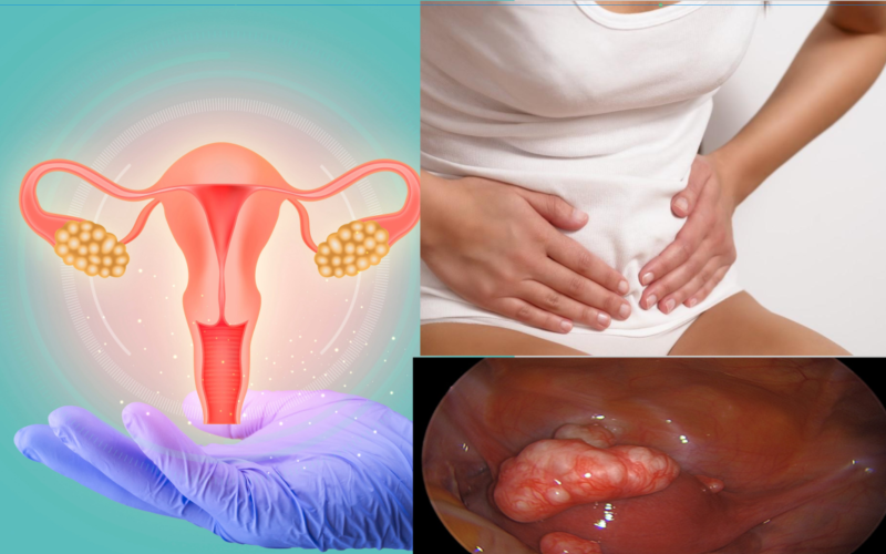 Tips On Getting Pregnant With Fibroids