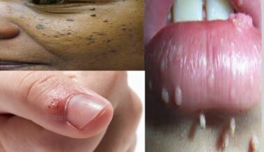 How to Manage Papillomas and Warts at Home